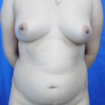 Fat Transfer to Breasts / Natural Augmentation Before & After Patient #7646