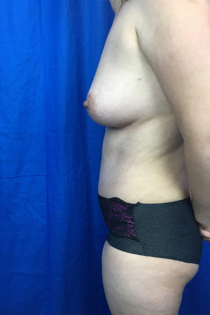 Fat Transfer to Breasts / Natural Augmentation Before & After Patient #7646