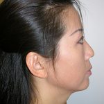 Facelift and Necklift Before & After Patient #7869