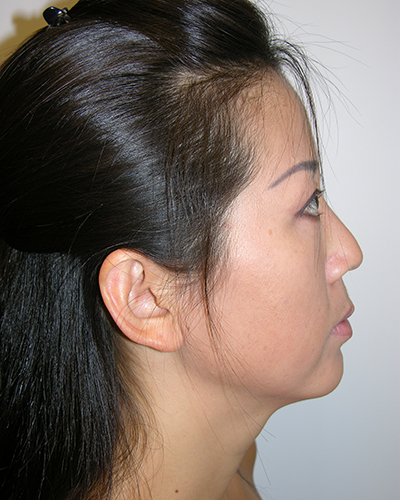 Facelift and Necklift Before & After Patient #7869