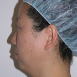 Facelift and Necklift Before & After Patient #7869