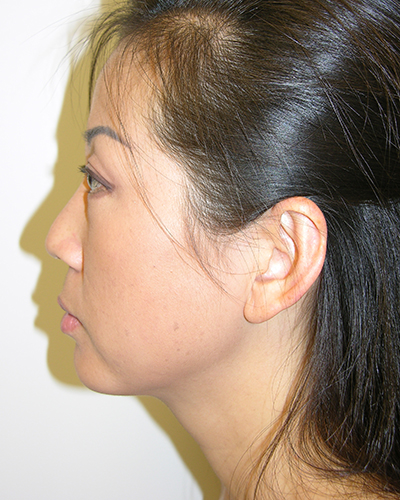 Facelift and Necklift Before & After Patient #7869