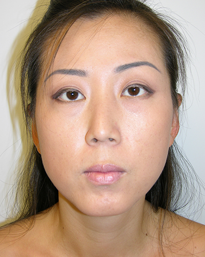 Facelift and Necklift Before & After Patient #7869