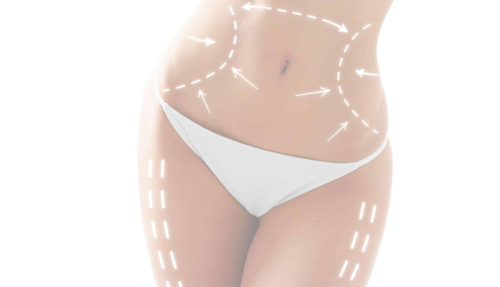 Liposuction