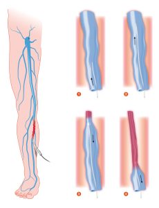 Varicose Veins Treatment Beverly Hills