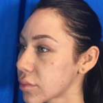Rhinoplasty Before & After Patient #9111
