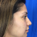 Rhinoplasty Before & After Patient #9179