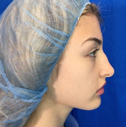 Rhinoplasty Before & After Patient #9186