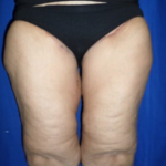Thigh Lift Before & After Patient #9197