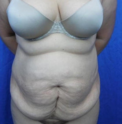 Tummy Tuck Before & After Patient #9200