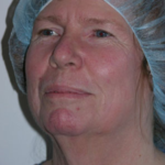 Facelift and Necklift Before & After Patient #9104