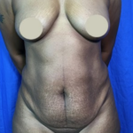 Tummy Tuck Before & After Patient #9213
