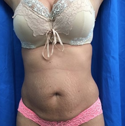 Tummy Tuck Before & After Patient #9228