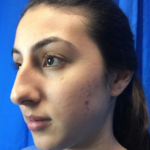 Rhinoplasty Before & After Patient #9118