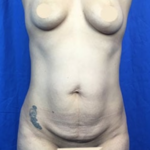 Tummy Tuck Before & After Patient #9233