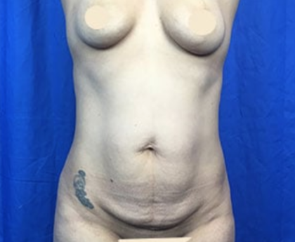 Tummy Tuck Before & After Patient #9233