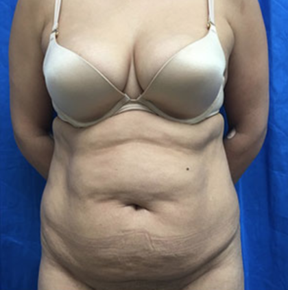 Tummy Tuck Before & After Patient #9238