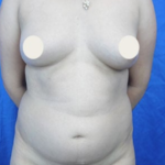 Tummy Tuck Before & After Patient #9257