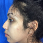Rhinoplasty Before & After Patient #9132