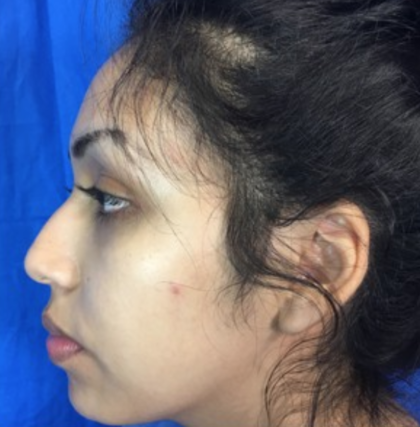 Rhinoplasty Before & After Patient #9132