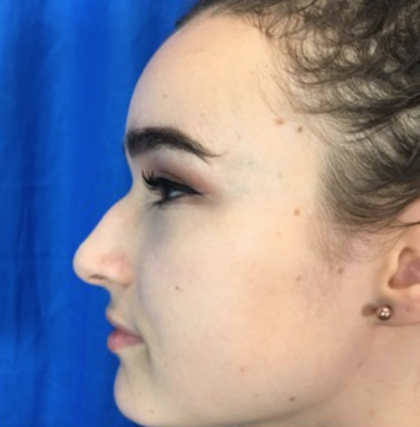 Rhinoplasty Before & After Patient #9148