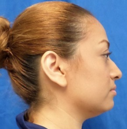 Rhinoplasty Before & After Patient #9153