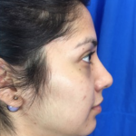 Rhinoplasty Before & After Patient #9179