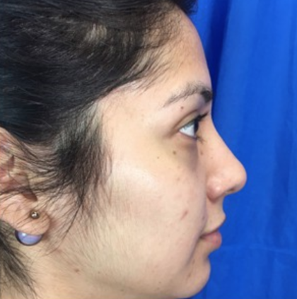 Rhinoplasty Before & After Patient #9179