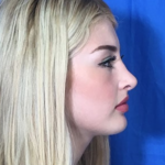 Rhinoplasty Before & After Patient #9186