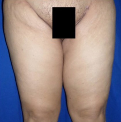 Thigh Lift Before & After Patient #9197
