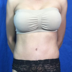 Tummy Tuck Before & After Patient #9207