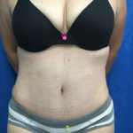 Tummy Tuck Before & After Patient #9223