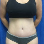 Tummy Tuck Before & After Patient #9233