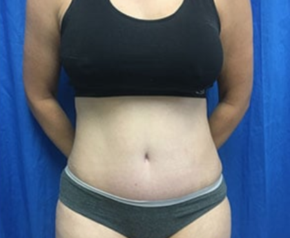 Tummy Tuck Before & After Patient #9233