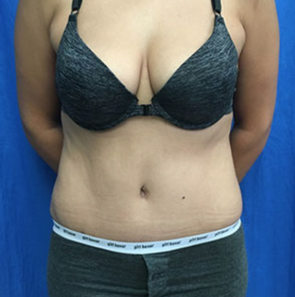 Tummy Tuck Before & After Patient #9238