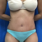 Tummy Tuck Before & After Patient #9243