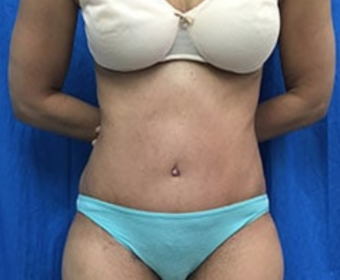 Tummy Tuck Before & After Patient #9243