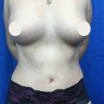 Tummy Tuck Before & After Patient #9257