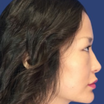 Rhinoplasty Before & After Patient #9125