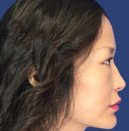 Rhinoplasty Before & After Patient #9125