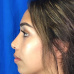 Rhinoplasty Before & After Patient #9132