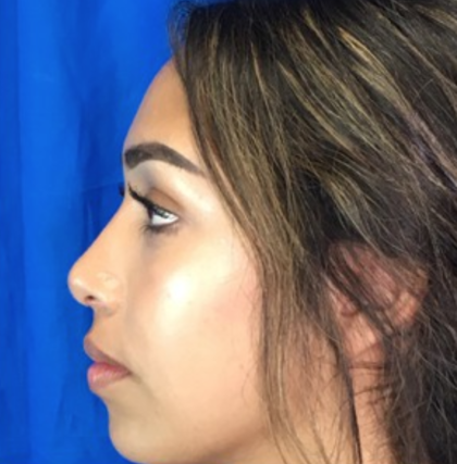 Rhinoplasty Before & After Patient #9132