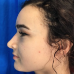 Rhinoplasty Before & After Patient #9148