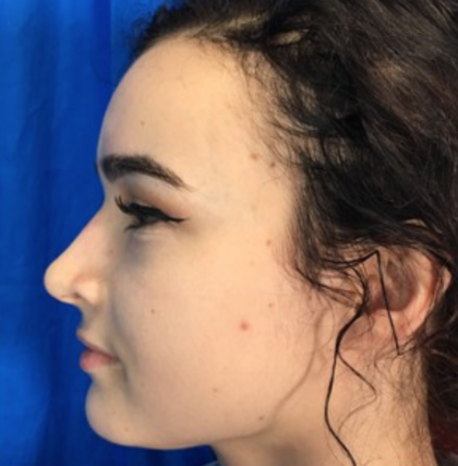 Rhinoplasty Before & After Patient #9148