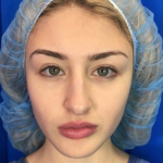 Rhinoplasty Before & After Patient #9186