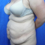 Tummy Tuck Before & After Patient #9200