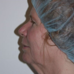 Facelift and Necklift Before & After Patient #9104