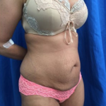 Tummy Tuck Before & After Patient #9228