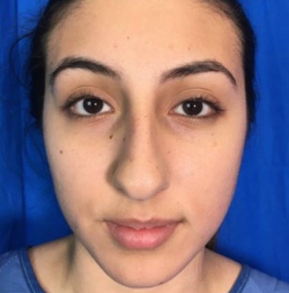 Rhinoplasty Before & After Patient #9118