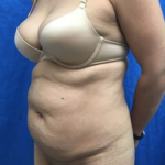 Tummy Tuck Before & After Patient #9238